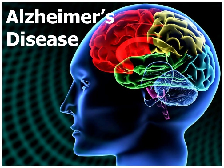 alzheimers disease pdf free download