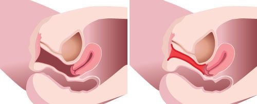 What is Virgin Tightening Surgery