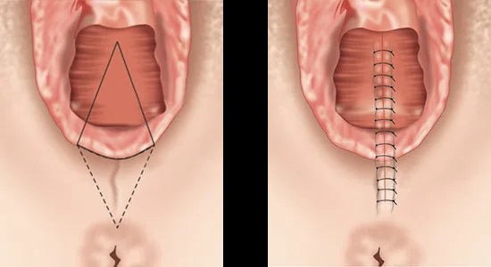 virgin tightening surgery before and after pictures