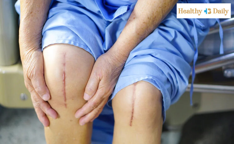 top 5 mistakes after knee replacement