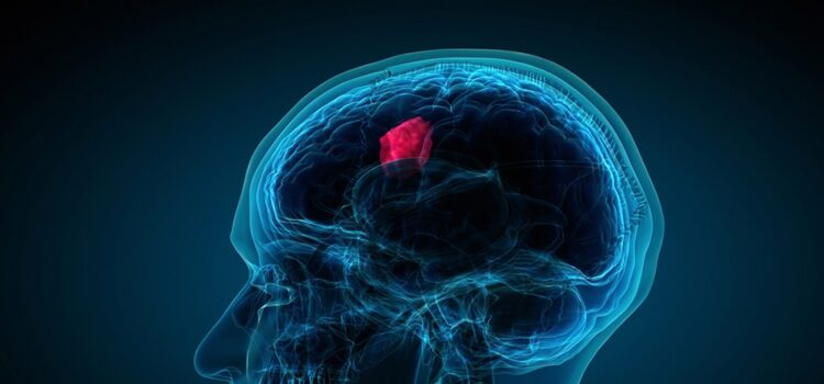 Navigating the Challenges of Glioblastoma Treatment