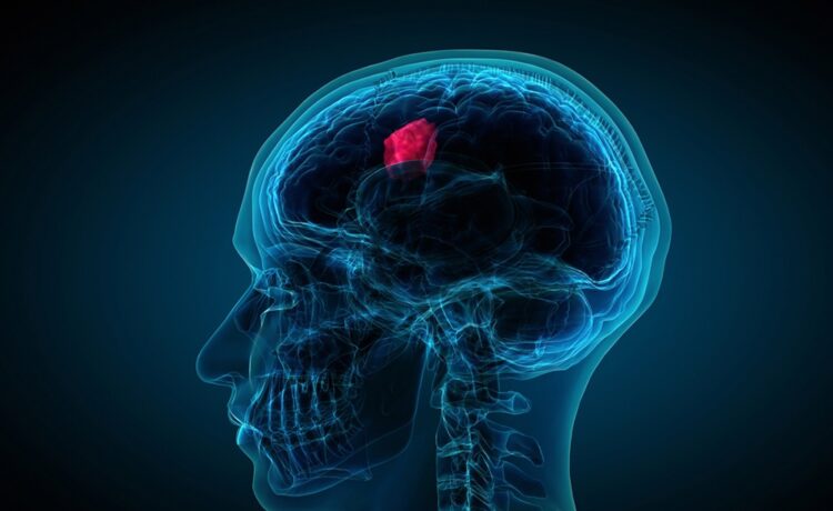 Navigating the Challenges of Glioblastoma Treatment