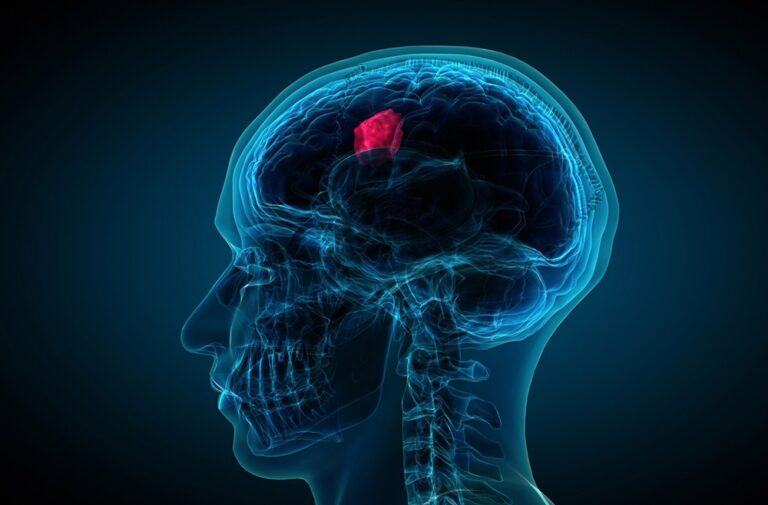 Navigating the Challenges of Glioblastoma Treatment