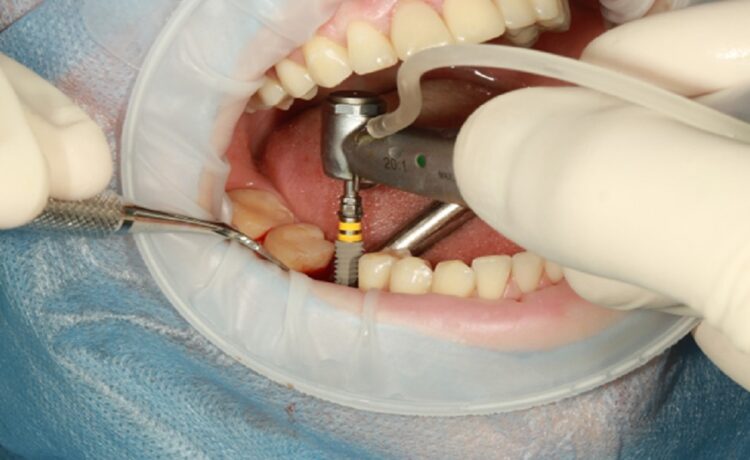 How To Take Care Of Your Dental Implants