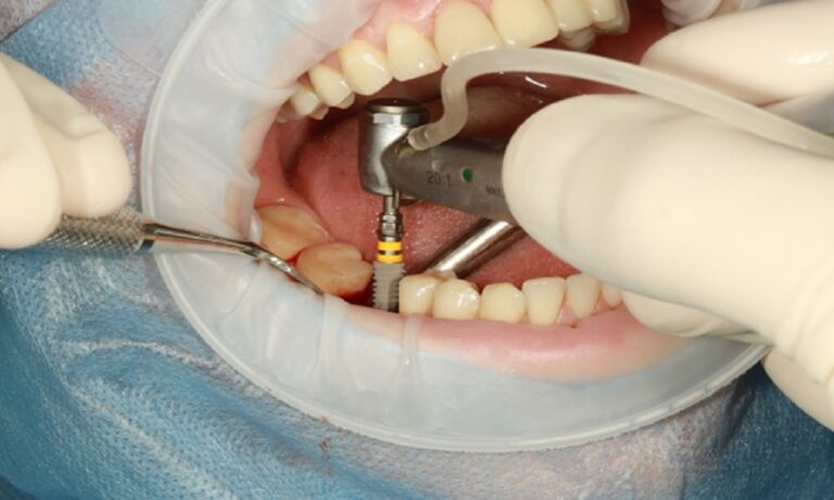 How To Take Care Of Your Dental Implants