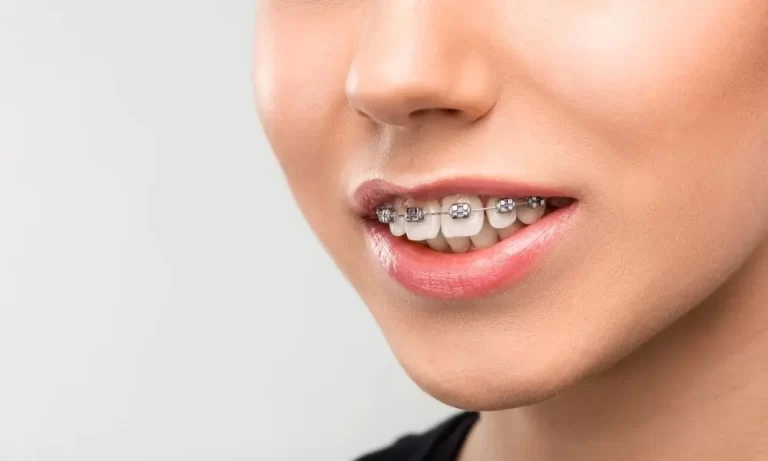 Bite Misalignment