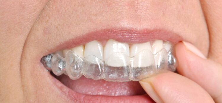 advantages of Invisalign