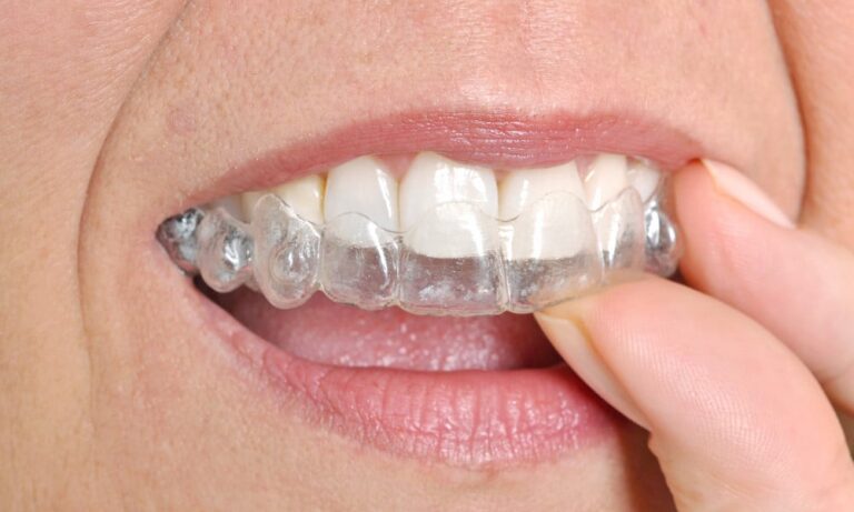 advantages of Invisalign
