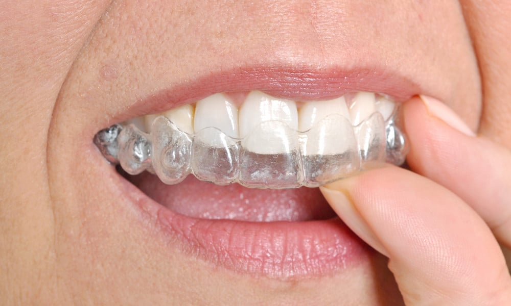 advantages of Invisalign