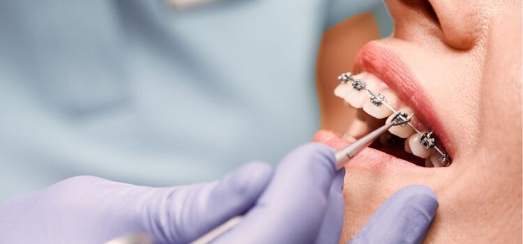 Orthodontic Accelerators