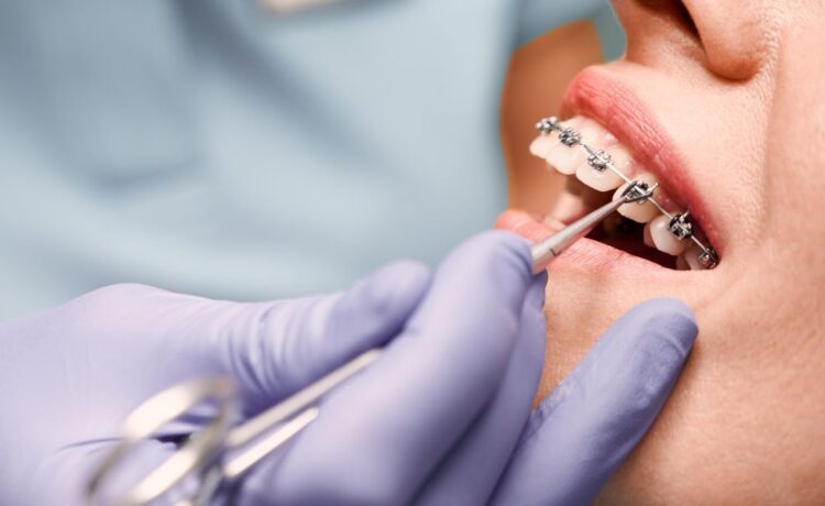 Orthodontic Accelerators