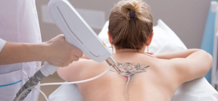 Tattoo Removal