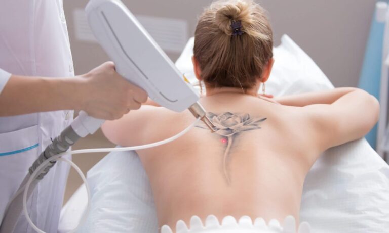 Tattoo Removal