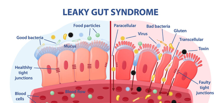 leaky gut