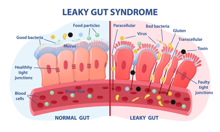 leaky gut