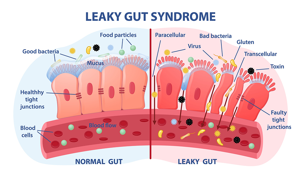 leaky gut